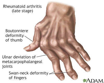 a könyökízület tünetei rheumatoid arthritis)