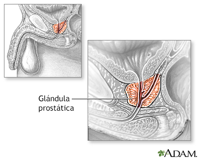 hiperplasia benigna de prostata e impotencia
