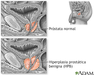 hiperplasia benigna de prostata e impotencia