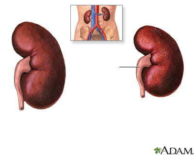 nefropatia diabetes riñon