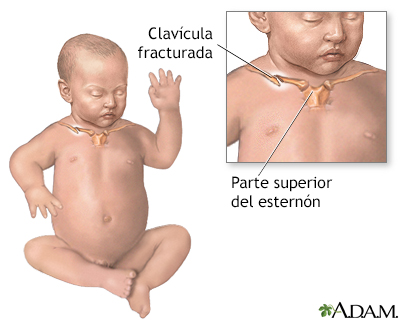 cocodrilo Variante he equivocado Fractura de clavícula en el recién nacido
