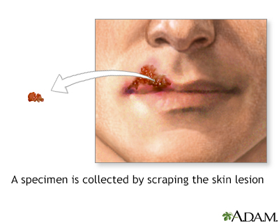 Viral lesion culture