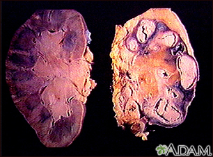 Tuberculosis in the kidney