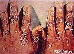 Warts, multiple - on hands