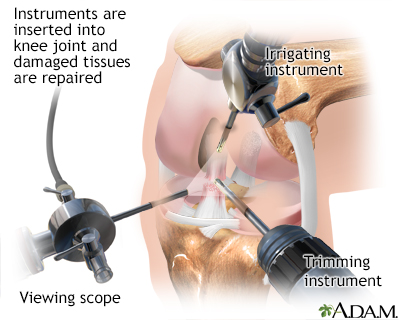 Arthroscopy