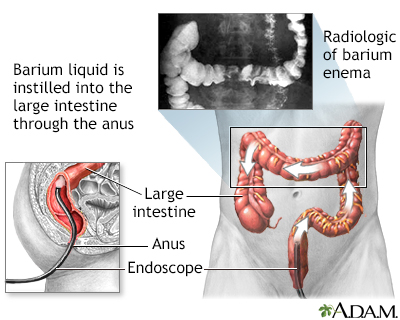 Barium enema