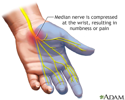 Carpal tunnel syndrome