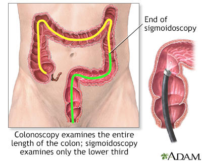 Colonoscopy