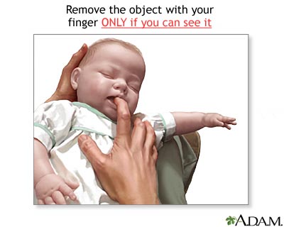 Heimlich maneuver on infant