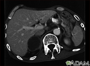 Adrenal metastases - CT scan