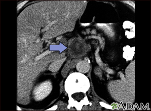 Pancreatic cancer, CT scan