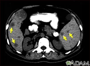 Spleen metastasis - CT scan