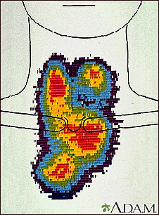 Thyroid enlargement - scintiscan