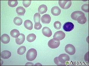 Megaloblastic anemia - view of red blood cells