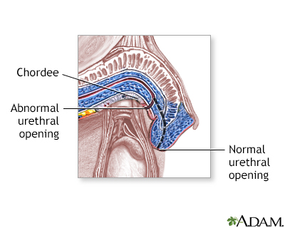 Hypospadias - Procedure