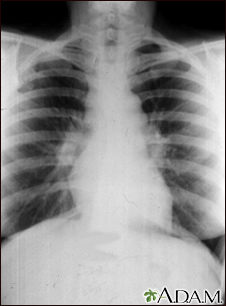 Sarcoid, stage I - chest X-ray