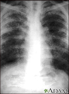 Sarcoid, stage II - chest X-ray