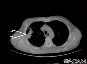 Lung mass, right lung - CT scan