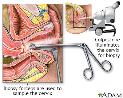 Colposcopy-directed biopsy