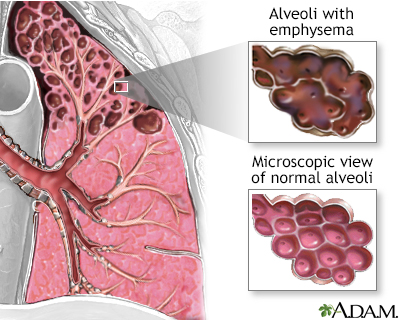 Emphysema