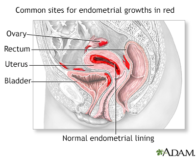 Endometriosis