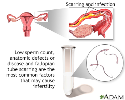 Infertility Factors 