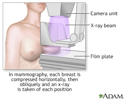 Mammogram