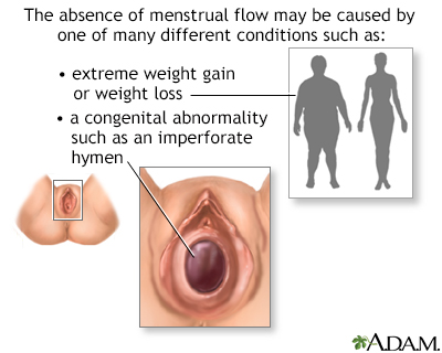 Absence of menstruation (amenorrhea)