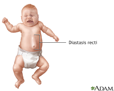 Diastasis recti