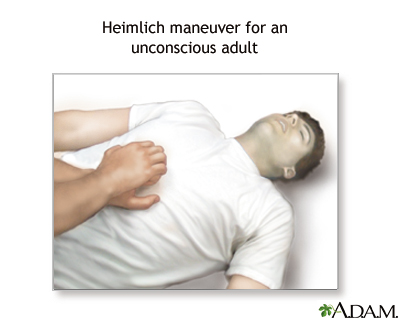 First Aid for Choking - unconscious adult or child over 1 year