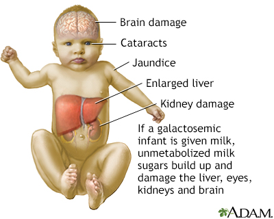 Galactosemia