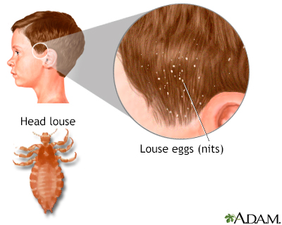 Head lice