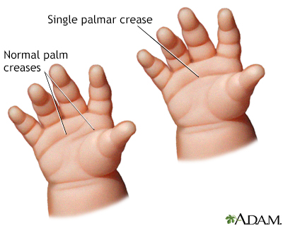 Single palmar crease