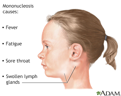 Mononucleosis infecciosa