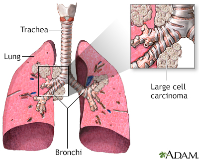 Non-small cell carcinoma