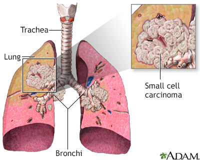 Small cell carcinoma