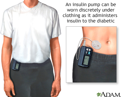 Insulin pump