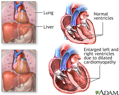 Alcoholic cardiomyopathy