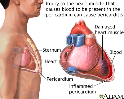 Pericarditis post-IM