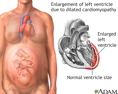 Peripartum cardiomyopathy