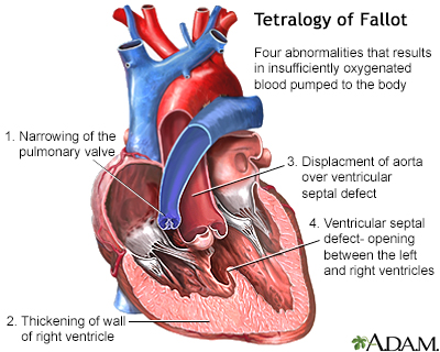 Tetralogy of Fallot