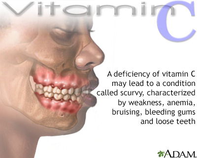 Vitamin C deficit