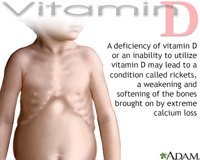 Vitamin D deficit