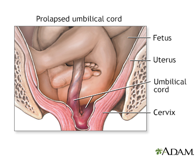 Prolapsed Umbilical Cord
