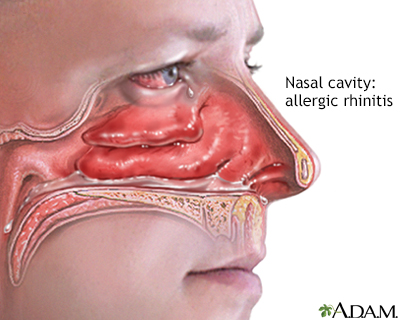 Allergic rhinitis