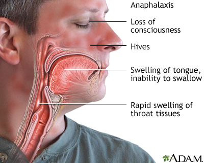 Anaphylaxis