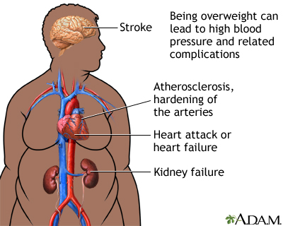 Obesity and health