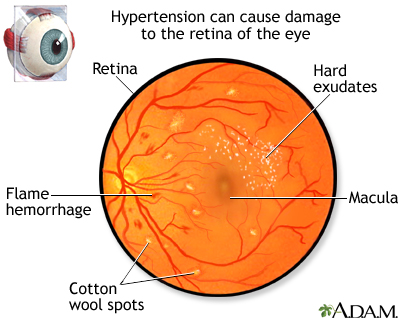 Hypertensive retinopathy