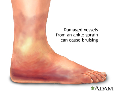 Ankle sprain swelling