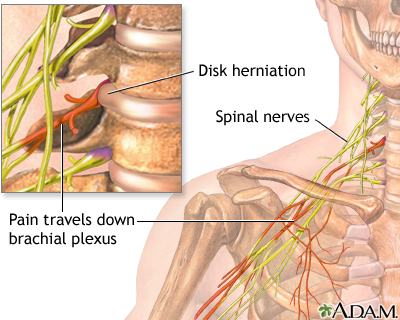 Neck pain